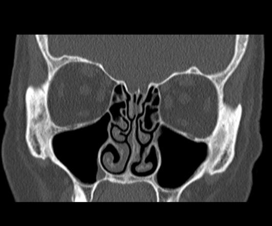 CT sinus 2