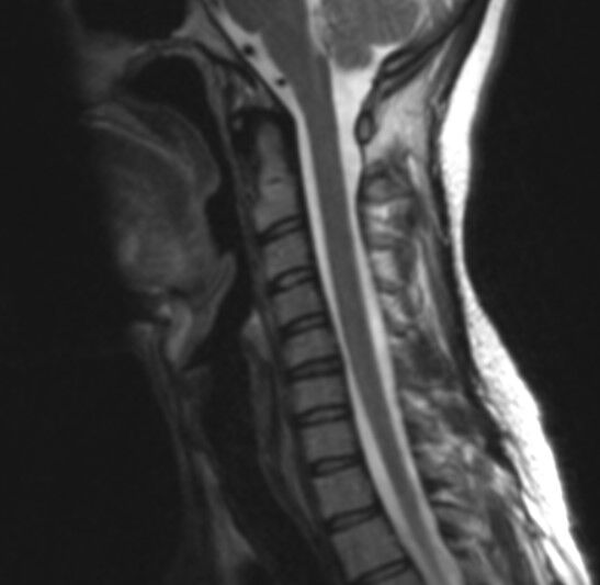 MR cervical thumb