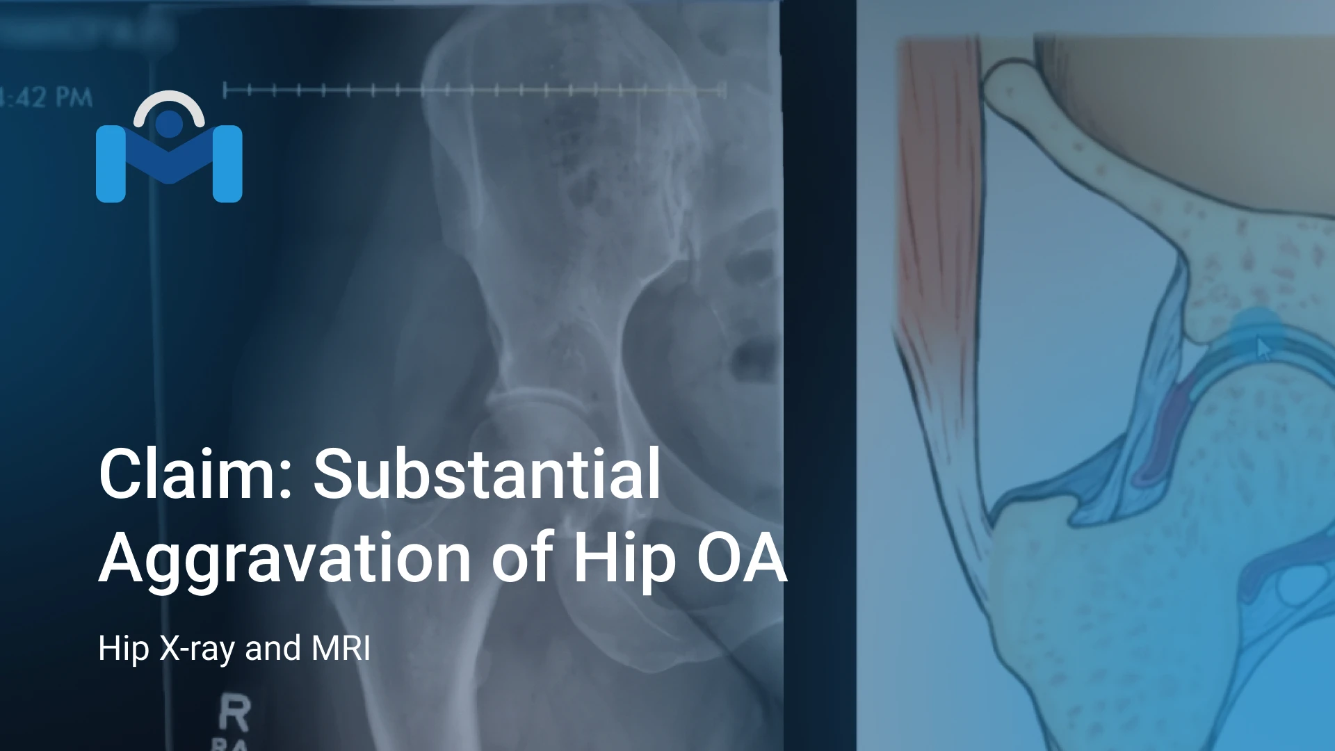 Claim: Substantial Aggravation of Hip OA