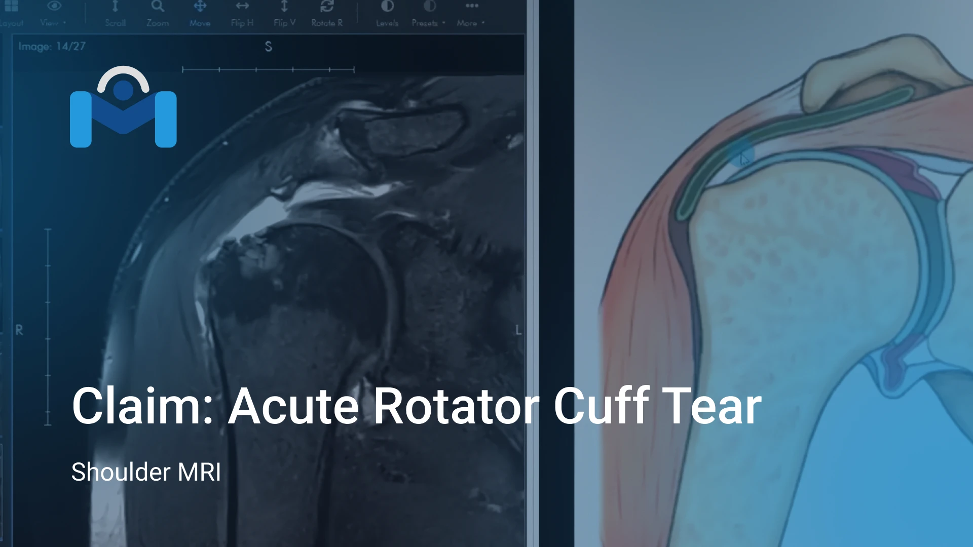 Claim: Acute Rotator Cuff Tear