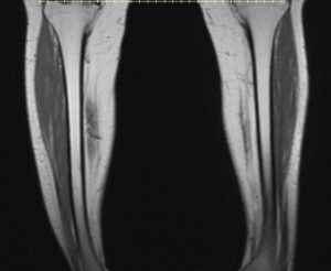 MRI Tibia/Fibula - Mediphany