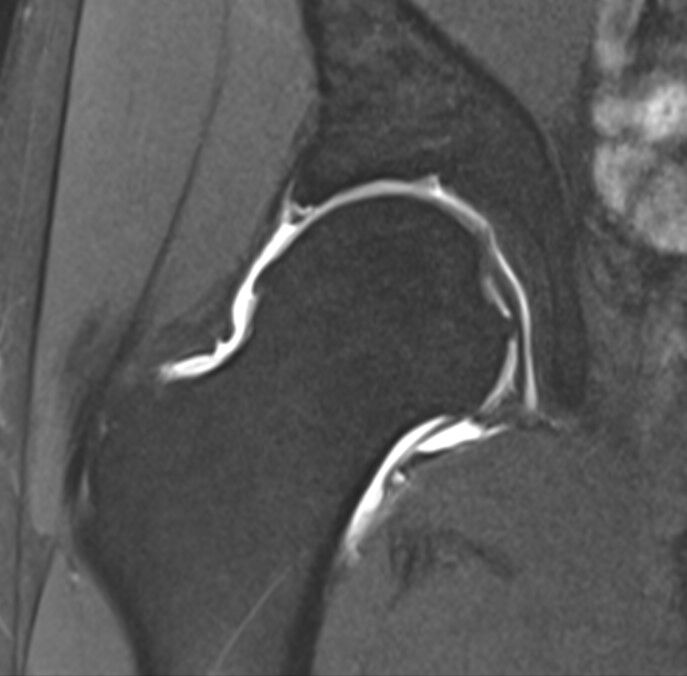 MR hip arthro thumbnail