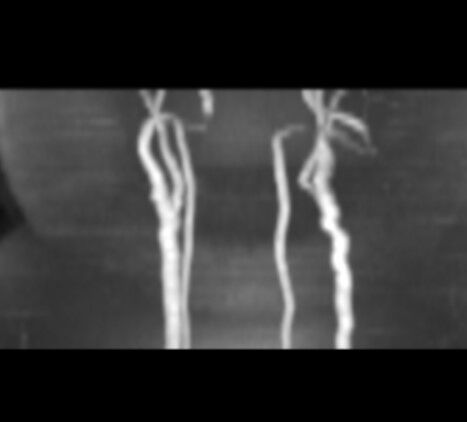 MRA carotids thumb